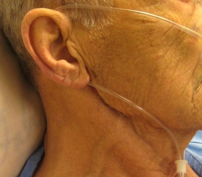 Nasal cannula over patient's ear