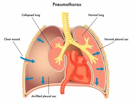 Illustration showing pneumothorax with the right lung deflated.