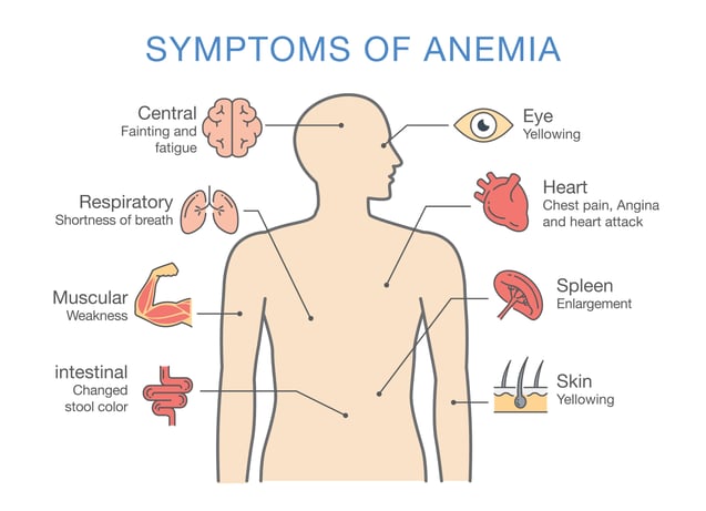 Anemia