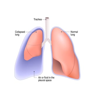 pneumothorax