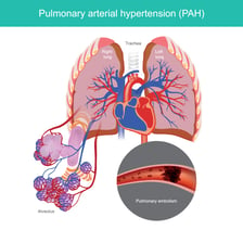 Легочная гипертензия картинки
