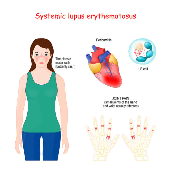 Systemic lupus erythematosus (SLE)