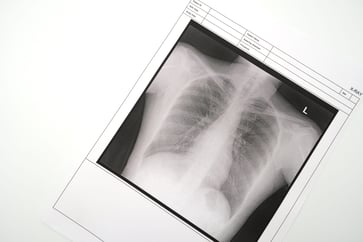 X-ray of the lungs