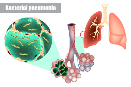 Bacterial pneumonia