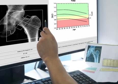 Osteoporosis testing