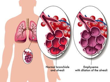 Illustration showing damaged alveoli due to emphysema.