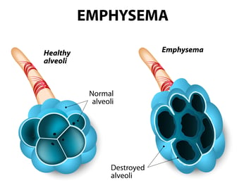 Emphysema diagram