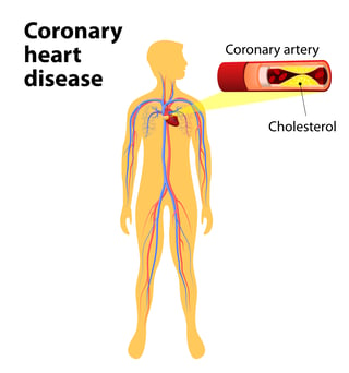 Coronary heart disease