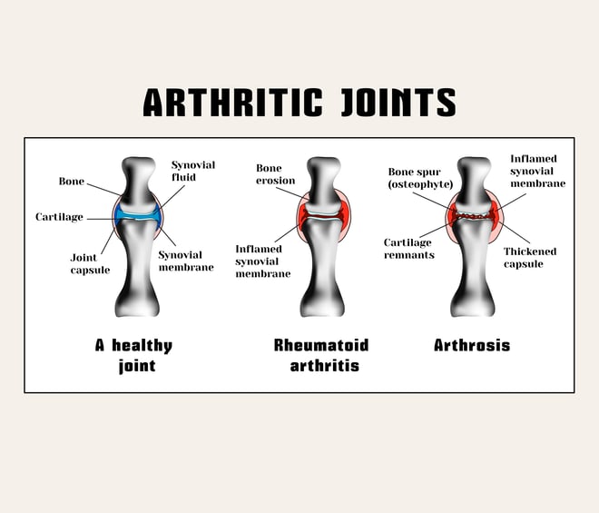 Rheumatoid arthritis