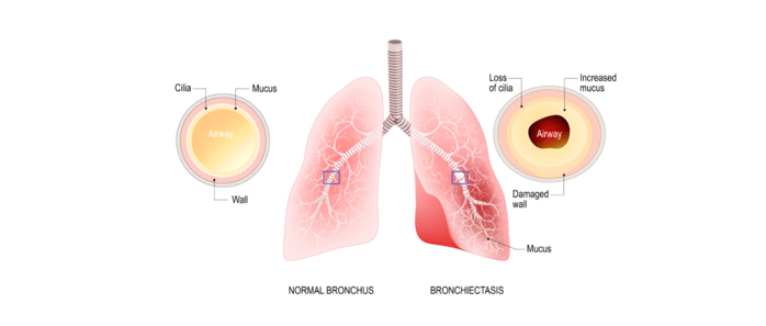 Damaged cilia in the lungs